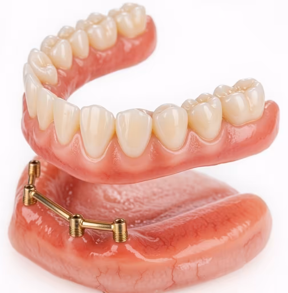 Smiles Peru Implant supported removible prosthesis Protesis removible implante dentales