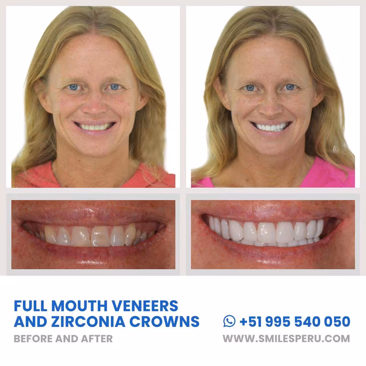 Dental Veneers before after Smiles Peru
