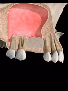 bone graft injerto óseo