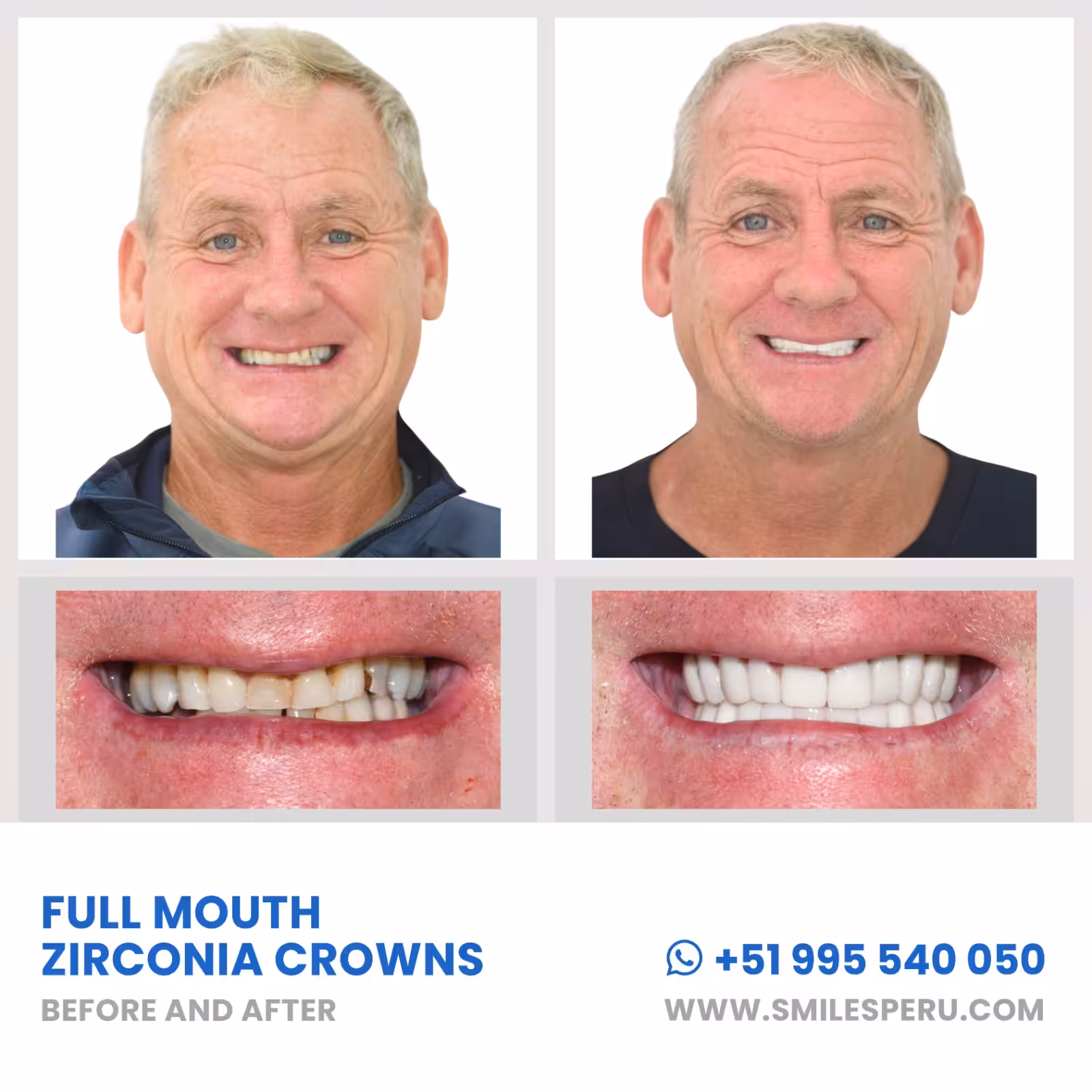 Coronas de Zirconio Smiles Peru