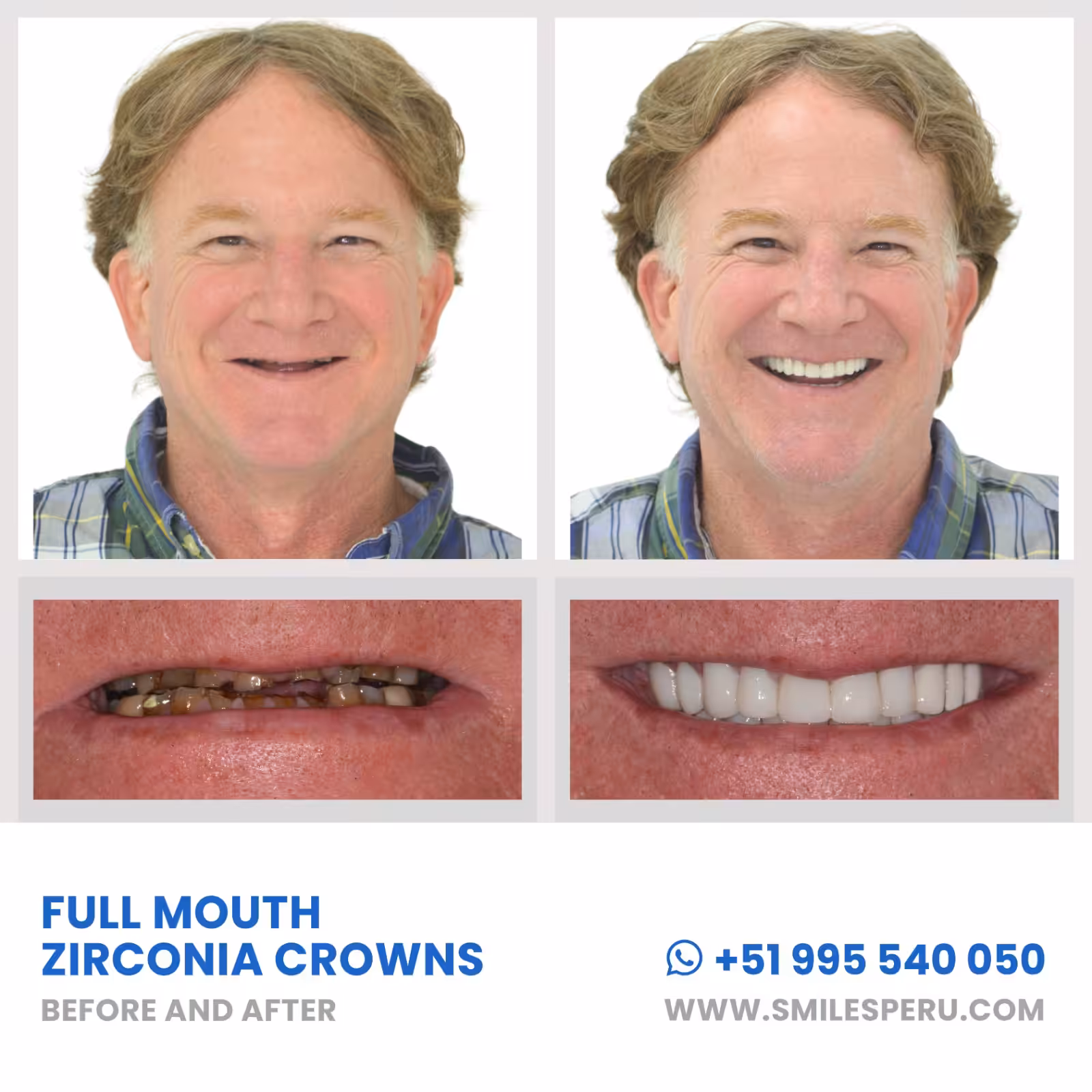 Smiles Peru Coronas de Zirconio CEREC