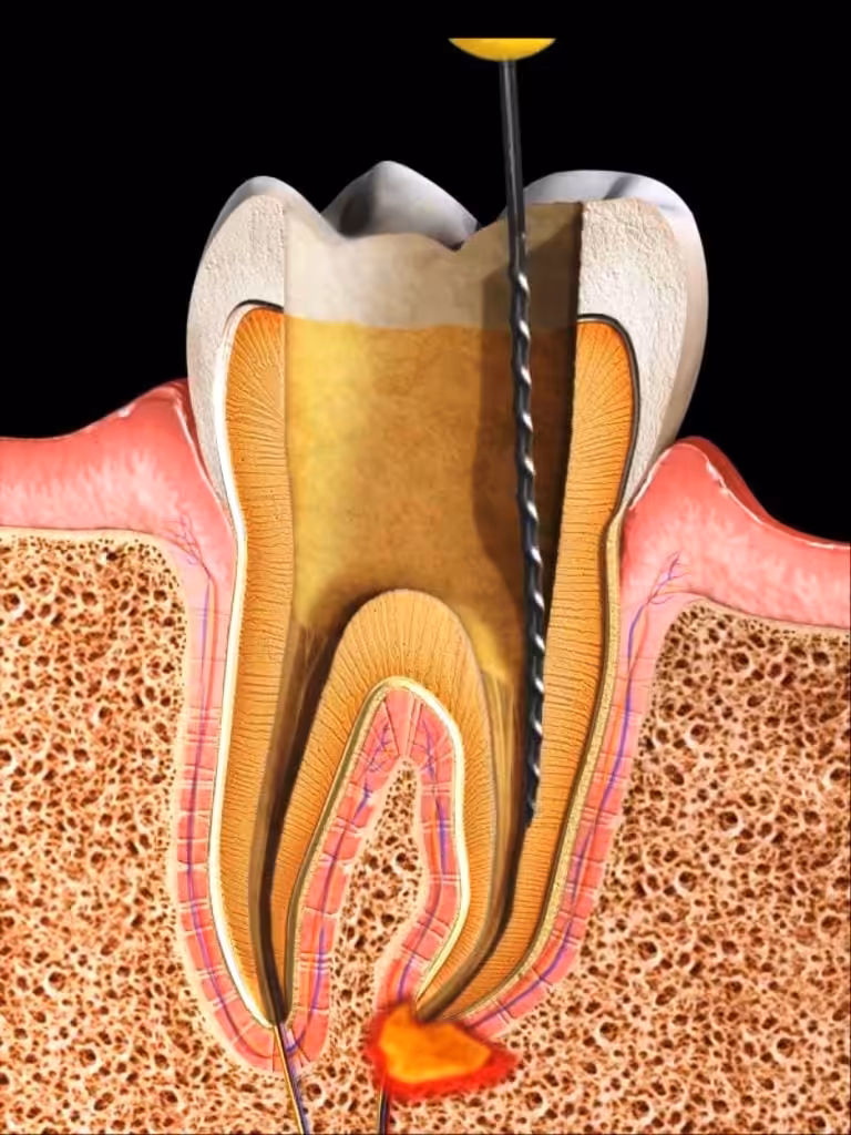 endodoncia