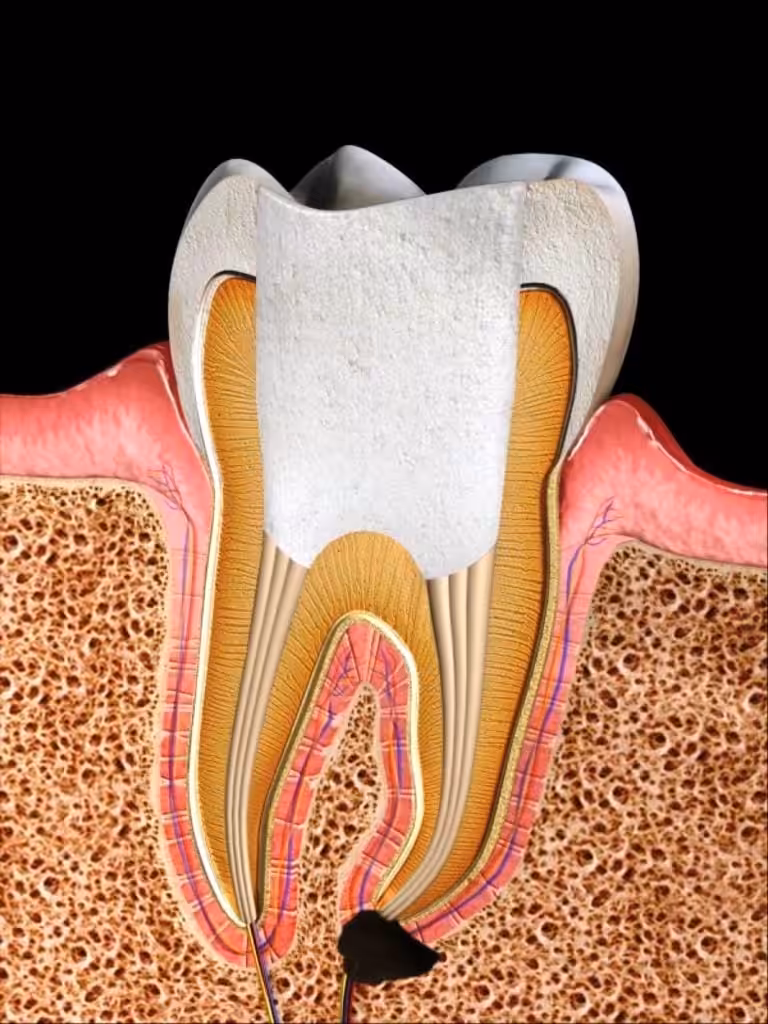 endondoncia tratamiento de conducto / root canal