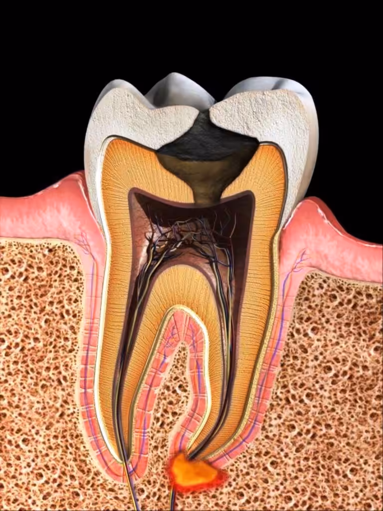 Tooth-Abscess